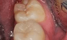 Cracked-Tooth-Repair-After-Image