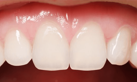 Dental-Bonding-After-Image