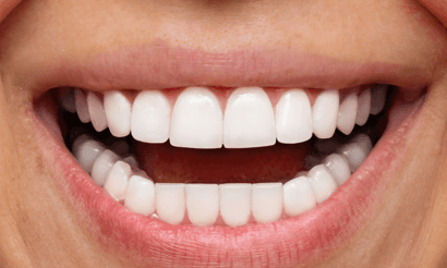 Porcelain-Veneers-After-Image