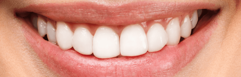 Teeth-Whitening-After-Image