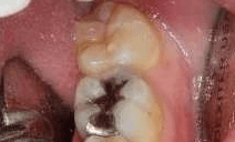 Cracked-Tooth-Repair-Before-Image