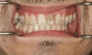 Crowns-Bridges-Before-Image