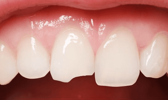 Dental-Bonding-Before-Image