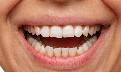 Porcelain-Veneers-Before-Image