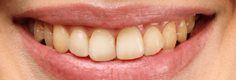 Teeth-Whitening-Before-Image